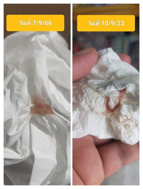 มูกเลือดออกครั้งที่2 สีเข้มกว่าเดิม