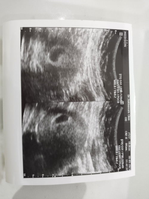 ซาวน์ยังไม่เจอตัวอ่อน