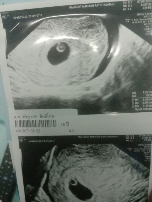 ถุงครรภ์เริ่มใหญ่แล้วค่ะมีแต่ไข่แดงแต่น้องไม่เห็นค่ะอยากเบอน้องเร็วๆค่ะ