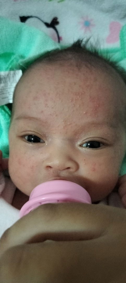 ตุ่มที่หน้าเด็กแรกเกิด