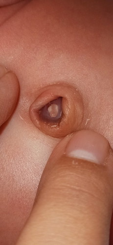 สะดือน้องหลุดได้2วันแล้วค่ะ แต่ยังไม่แห้งเหมือนในรูป ต้องไปหาหมอมั้ยคะ หรือควรทำยังไงดี