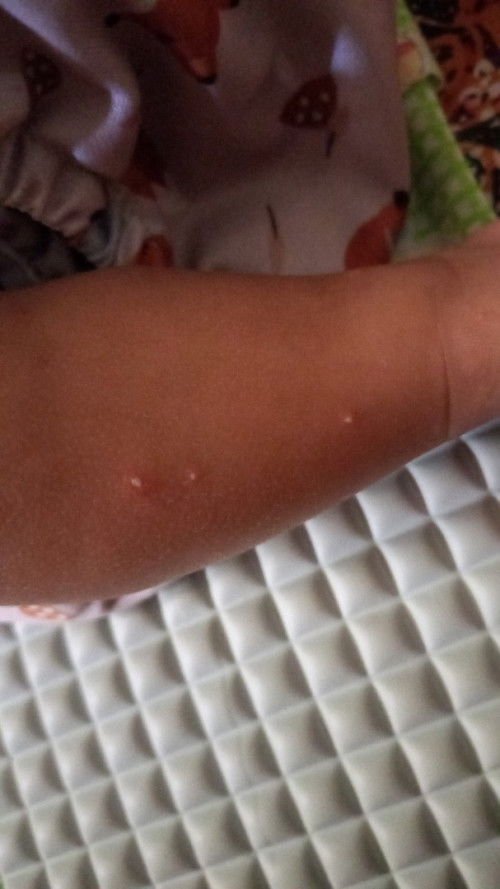 Eksim atau psoriasis