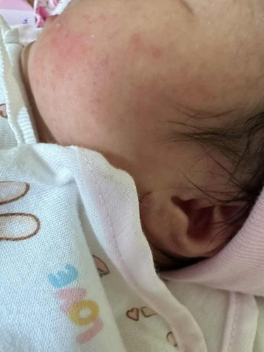สอบถามแม่ๆ น้องมีผื่นแบบนี้ เกิดจากอะไรค่ะ