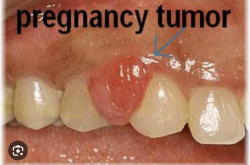 Pregnancy Tumor on gums