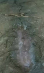 Sino po cs dito na bumuka yung bandang baba ng tahi