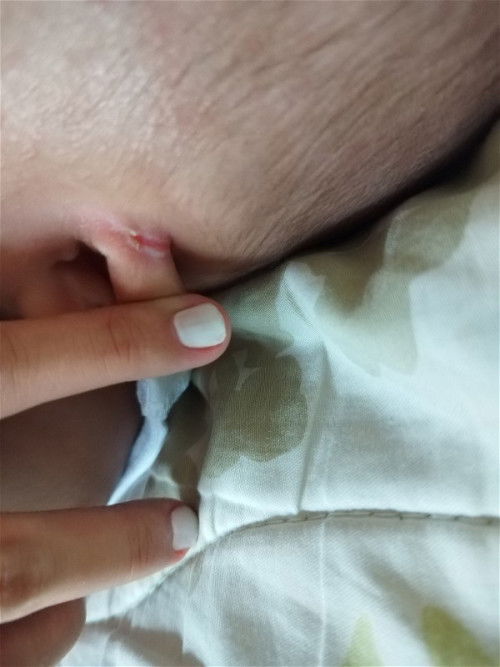 SUGAT SA TENGA NI BABY