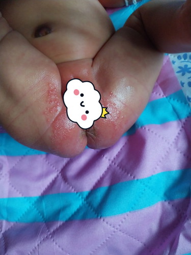 ผื่นผ้าอ้อม