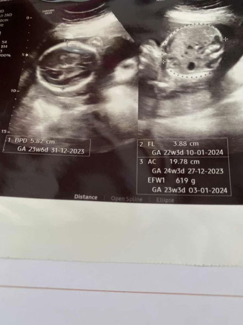 Lingkar kepala dan perut selisih seminggu lebih