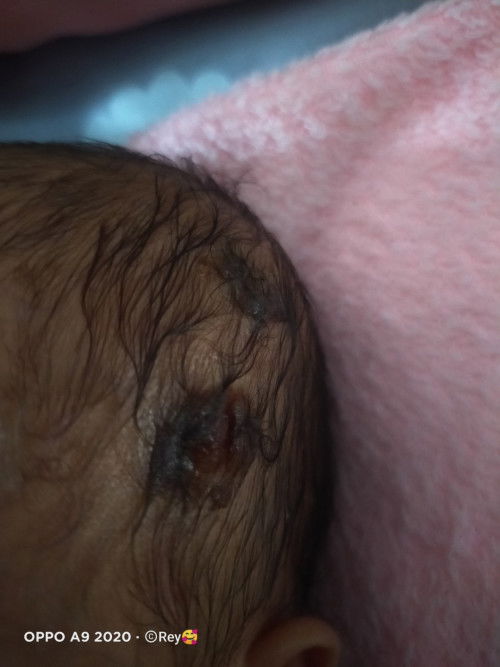 Kepala bayi Newborn melenting bernanah