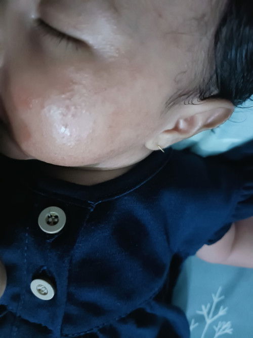 Pipi bayi merah bruntusan