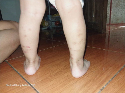 Any recommend soap or ointment po sa ganitong skin type ? 🥲