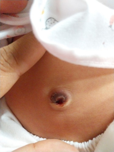 สะดือหลุดมีเลือด