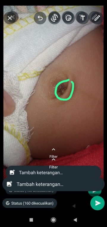 Pusar bayi newborn 20 hari