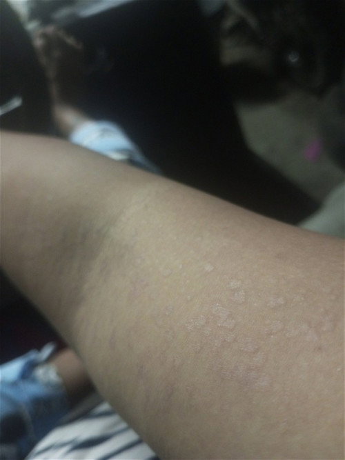 Itchy skin