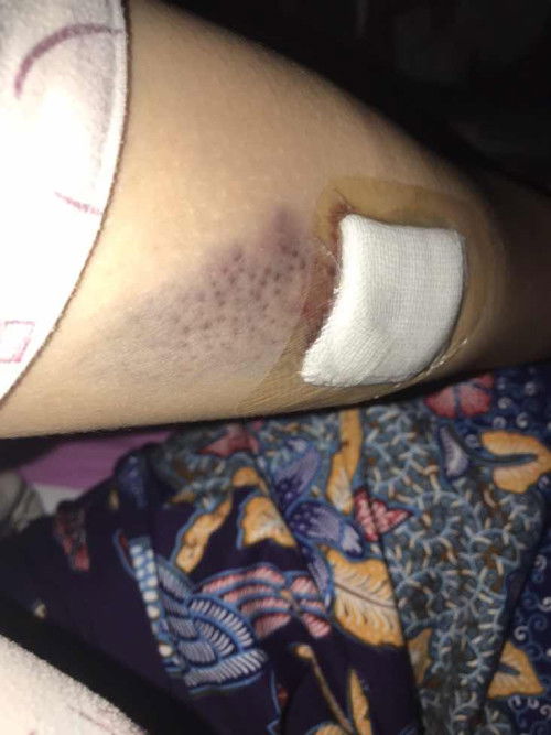 ฝังยาคุมวันแรก