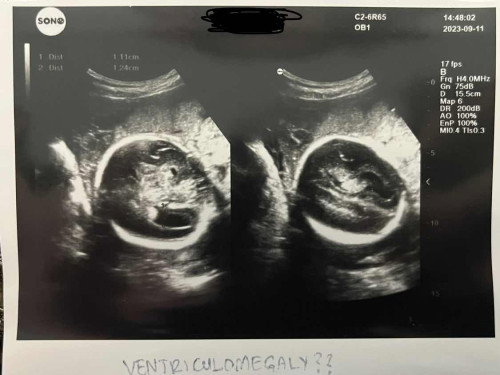 Ventriculomegaly
Apa punca boleh jd macamni ye mommies🥲 sedih rasa bila dpt tahu bila detail scan td
