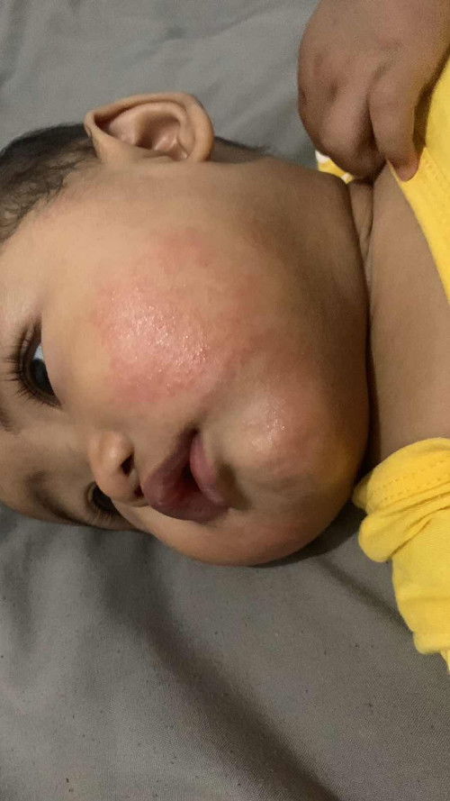 Alergi atau hal biasa?