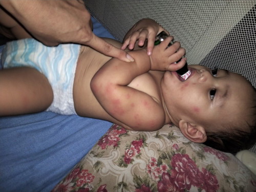 tanung ko lang po, ano pong tawag sa mga pantal sa katawan ng baby parang kagat po ng lamokπππ