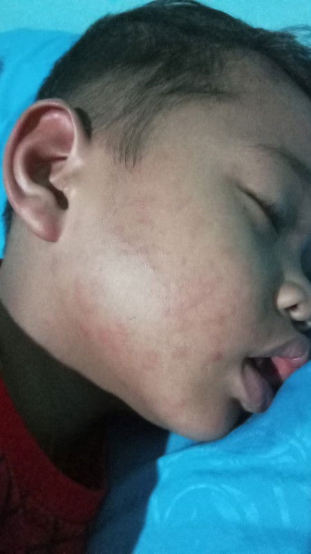 Bertanya , ruam merah pada anak