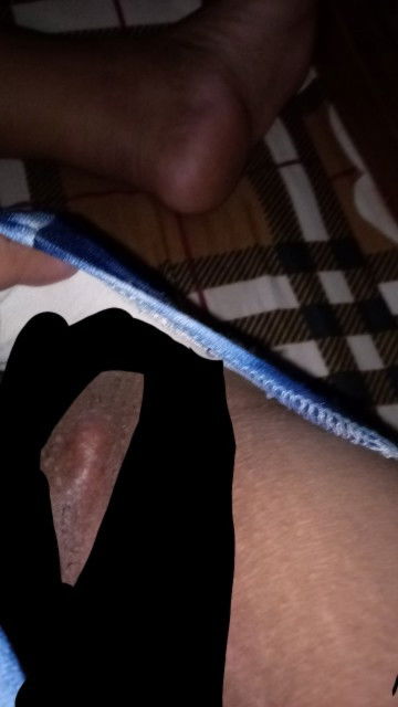 kulani sa singit po ba ito ?
sorry po sa pic mga mii...