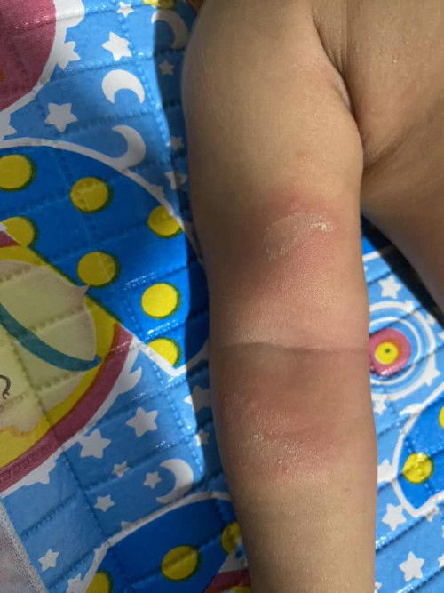 bayi 1,5 bulan tangan merah dan bernanah