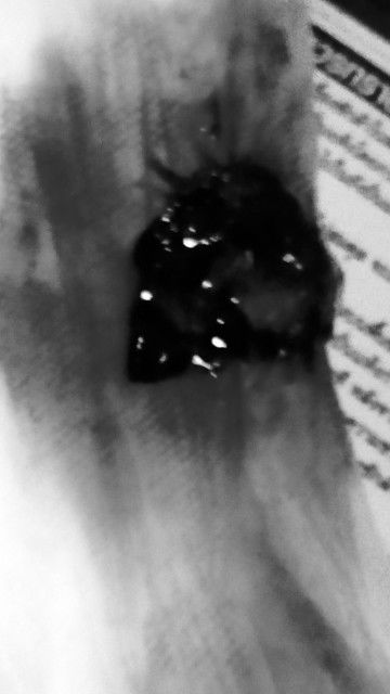 หลังคลอดได้ 7 วัน มีลิ่มเลือด