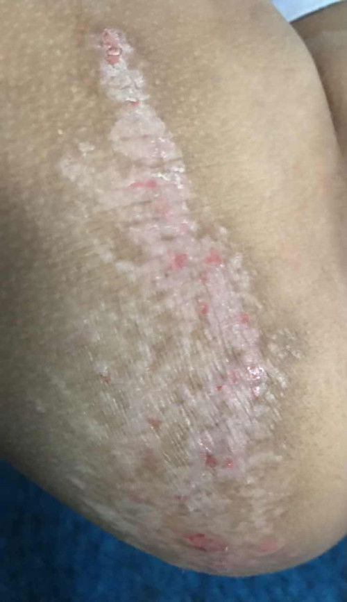 Kulit kering + gatal