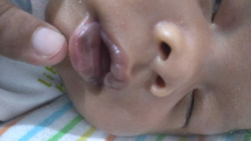 Bibir bayi menghitam