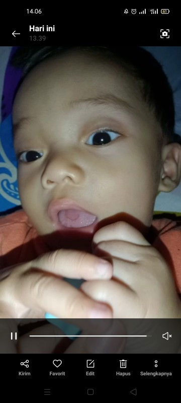 lidah bayi setelah MPASI bagian tengah nya begitu kira" aman ga ya mom?? ,jdi ga ada putih putih nya