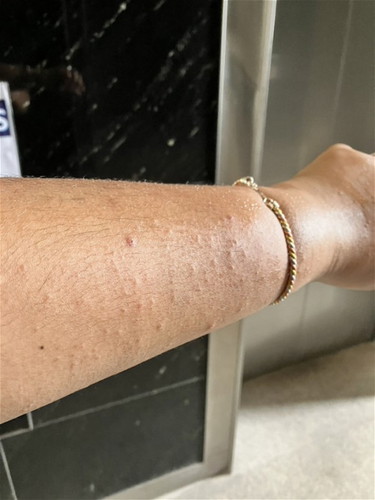 Rash in 2nd & 3rd Trimester