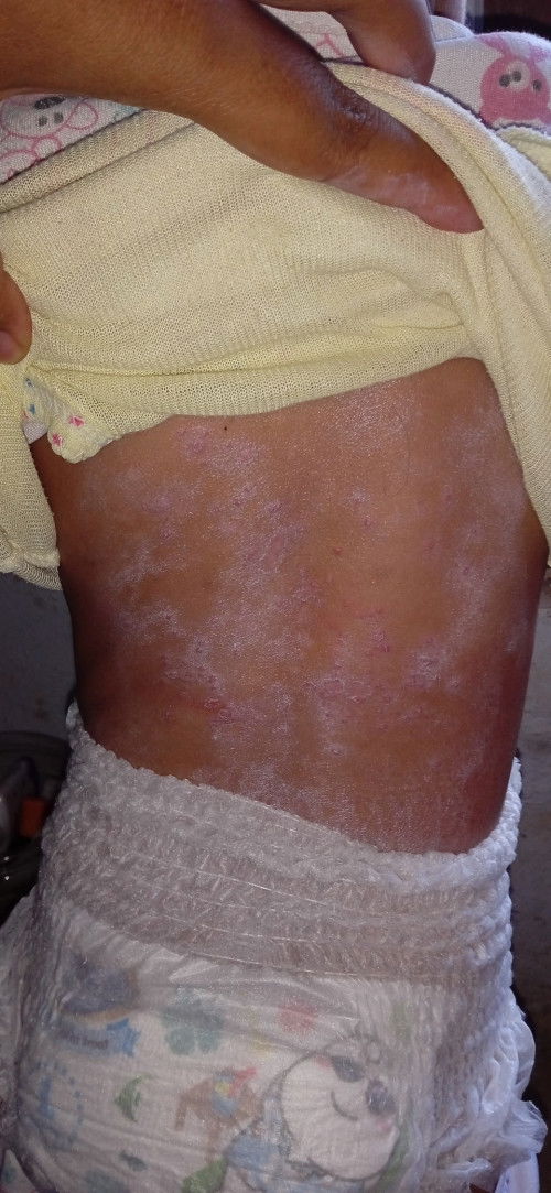 Gatal atau alergi ya, badan panas hampir 1 minggu