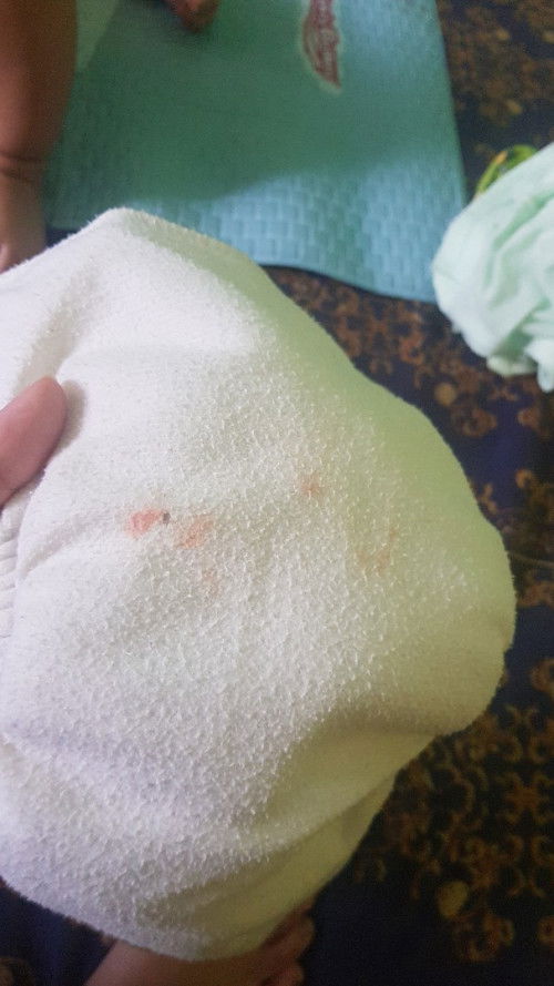 Fimosis pada bayi laki laki