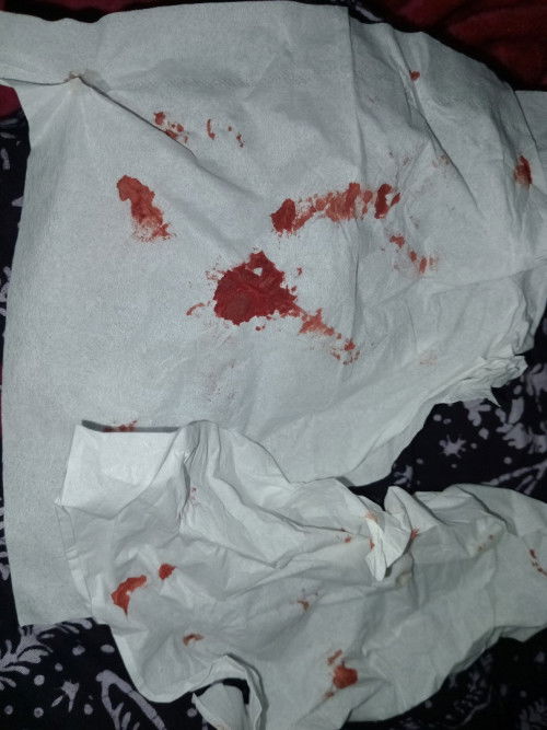 Apakah mimisan pada bumil berbahaya?