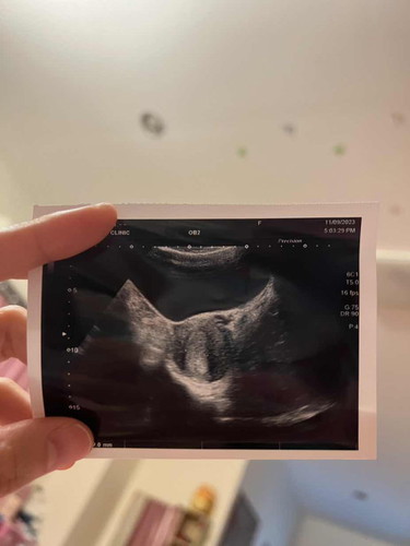 สอบถามว่านี่คือถุงตั้งครรภ์ไหมคะ