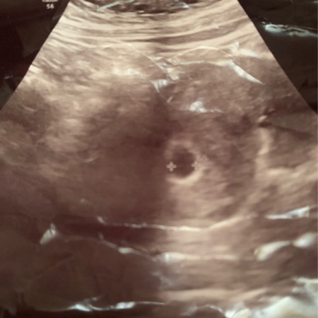 Scan 6w5d Nampak Kantung Je 🥹