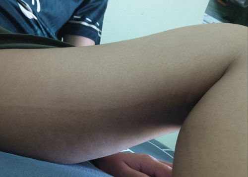 เส้นที่ขาเกิดจากอะไร นานไหมกว่าจะหาย