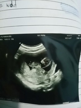 Kenapa ya dok bb aku mlh trun di 12 week ini apa karna aku gk bisa tidur si mlm hari ...? Apa solusi