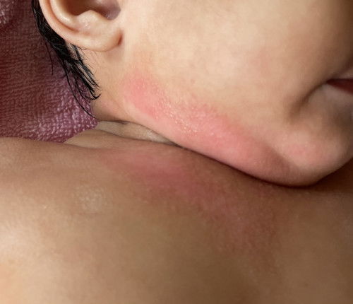Ruam susu di leher