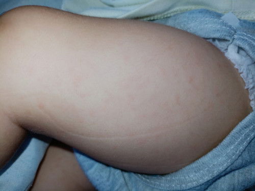 Allergy or rashes