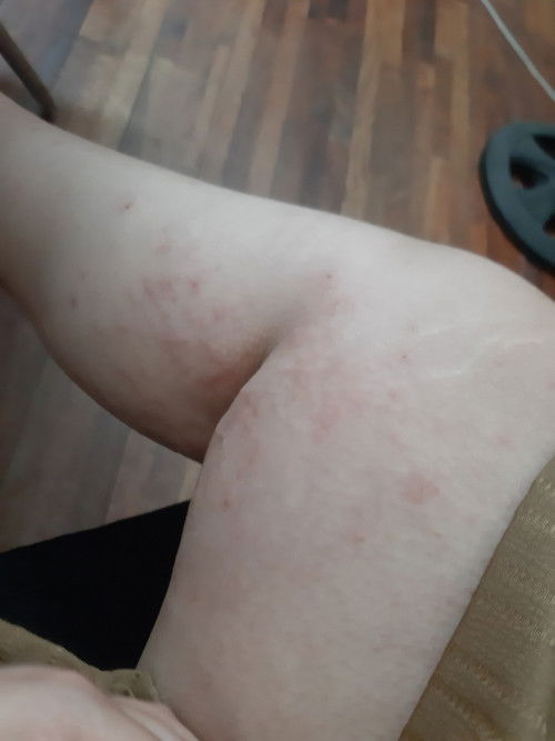 Bầu bị ngứa chân