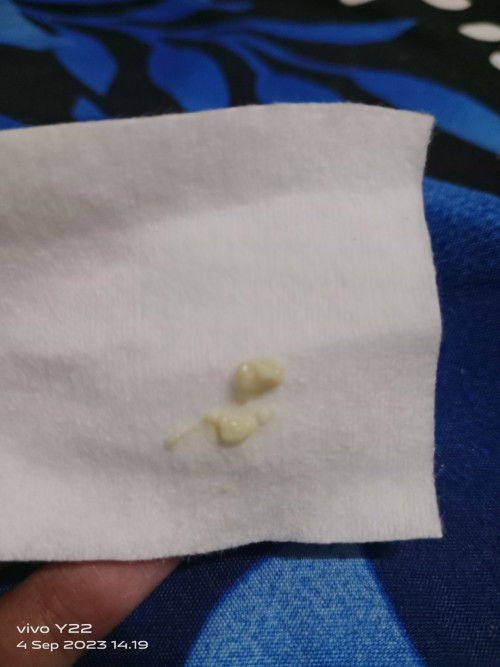 Hamil 14mg keputihan seperti ini apakah normal?