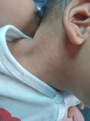 Các mom cho e hỏi con e 1 tháng 5 ngày mà cổ nổi nốt này nhiều thì bôi gì cho hết ạ.
