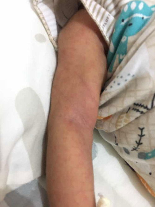 Bintik merah pada newbron