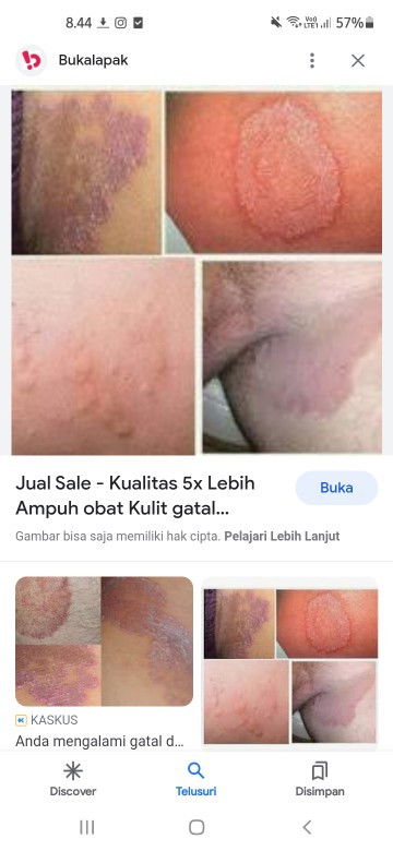Bun apa ada yg pernah ngalamin gatal seprti yg d fto pas hamil