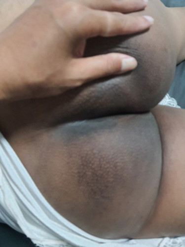 สอบถามแม่ๆบ้านไหนก้นดำตอนตั้งครรภ์ไหมคะ