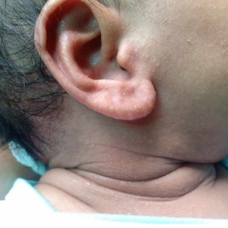Pa help po momies my rashes po baby ko 1 m. old po, normal lng po ba ito or need medication?thanks p