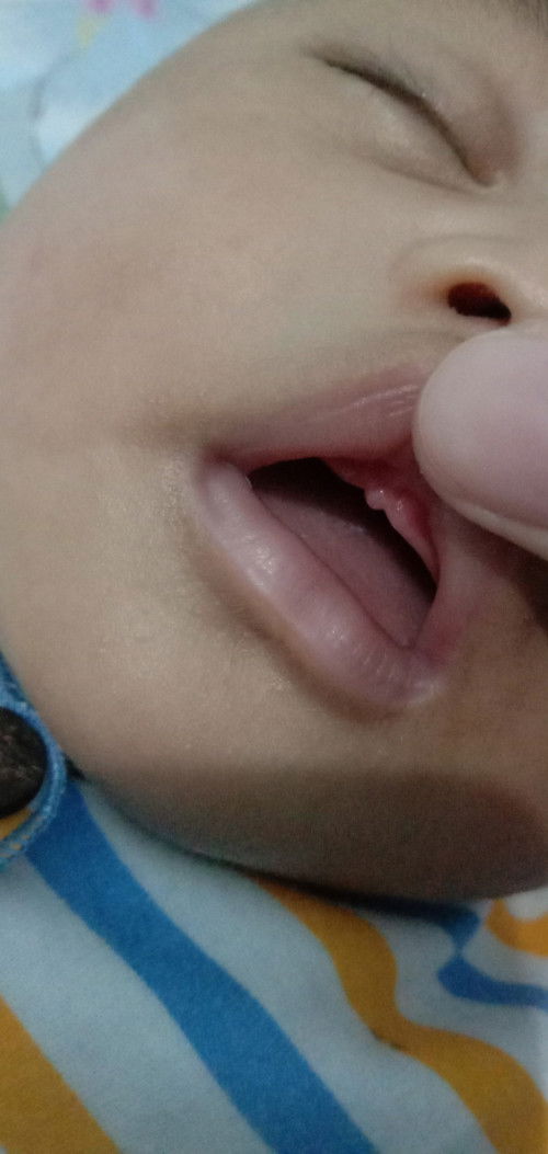 Masalah gusi dan tekstur BAB