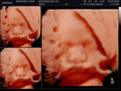 อัลตราซาวด์4มิติ