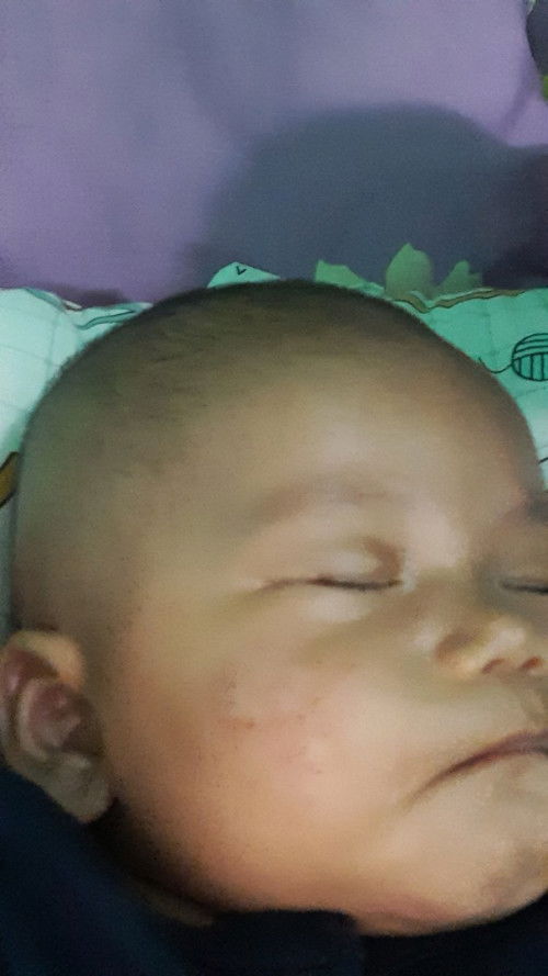 Pipi merah² bintik² kasar semakin melebar bbrp hari ini kira2 dikasih apa ya bun biar sembuh????