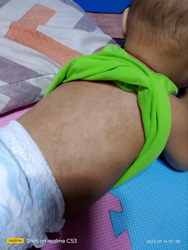 Ano po kaya nasa likod ng baby ko? 8month old at anong pong pamahid pwdeng ilagay